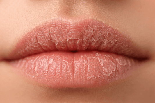 ¿Por qué se resecan los labios?